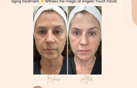 Eye Lifting Radio Frequency Facial Special